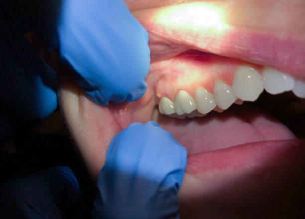 Best Emergency Dental Care for Abscessed Tooth in Quincy, MI